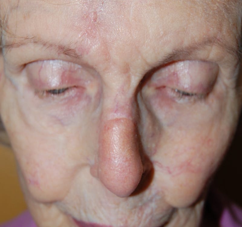 Mohs Nose Before & After Gallery - Patient 372745 - Image 2