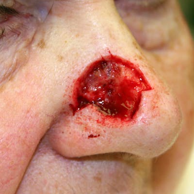 Mohs Nose Before & After Gallery - Patient 427559 - Image 1