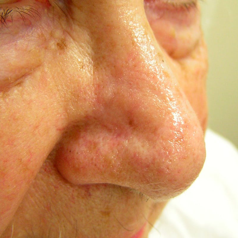 Mohs Nose Before & After Gallery - Patient 427559 - Image 2
