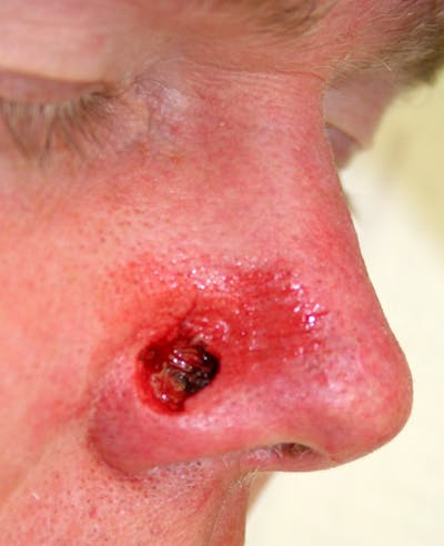 Mohs Nose Before & After Gallery - Patient 377767 - Image 1