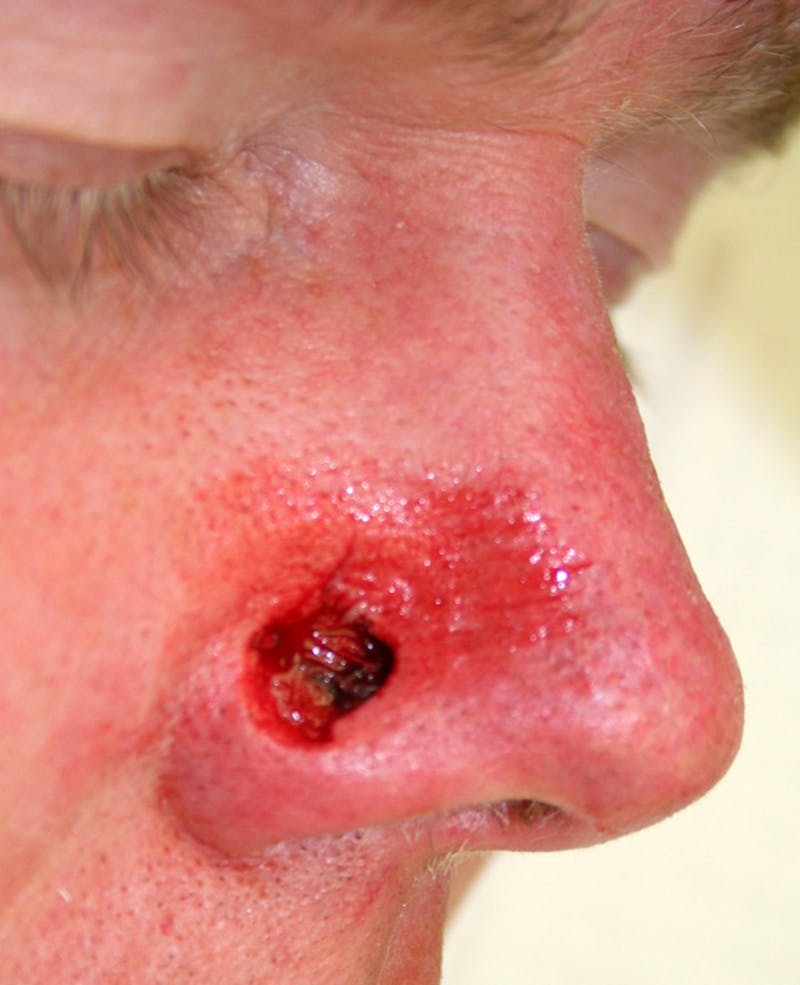 Mohs Nose Before & After Gallery - Patient 377767 - Image 1