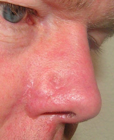 Mohs Nose Before & After Gallery - Patient 377767 - Image 2