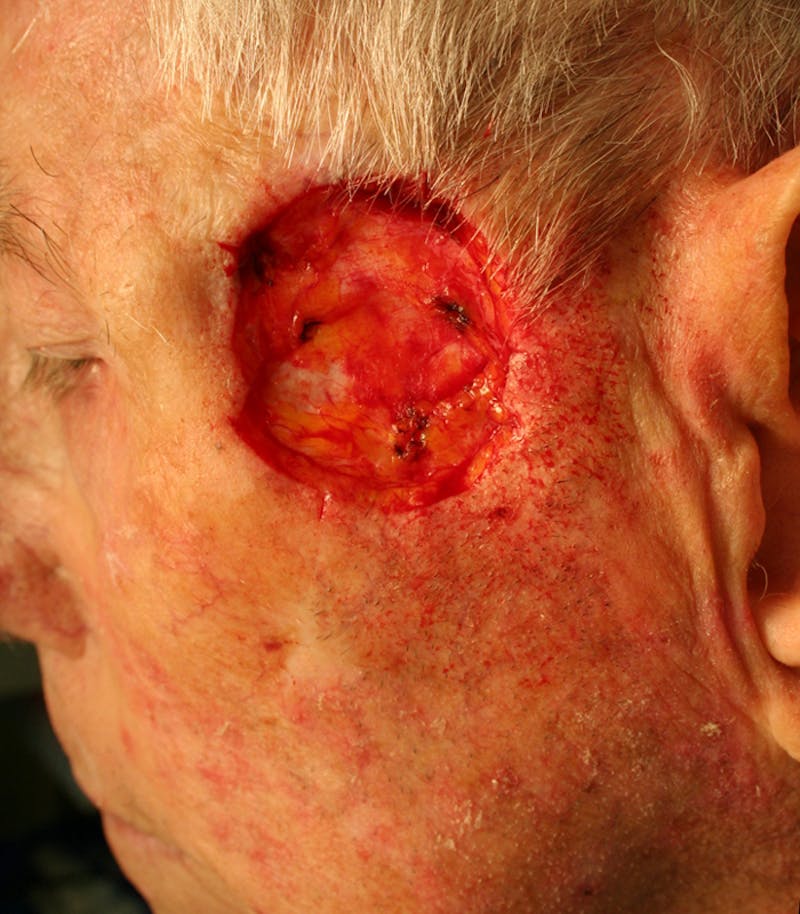 Mohs Temple Before & After Gallery - Patient 254971 - Image 1