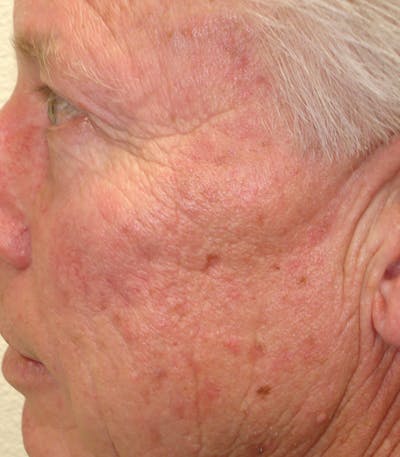 Mohs Temple Before & After Gallery - Patient 254971 - Image 2