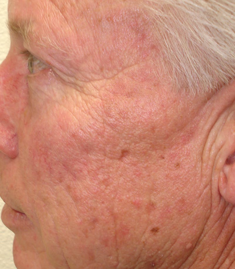 Mohs Temple Before & After Gallery - Patient 254971 - Image 2