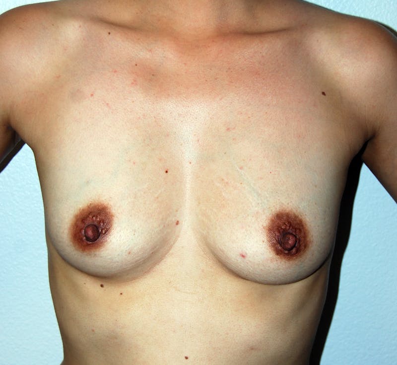 Breast Augmentation Before & After Gallery - Patient 101811 - Image 1