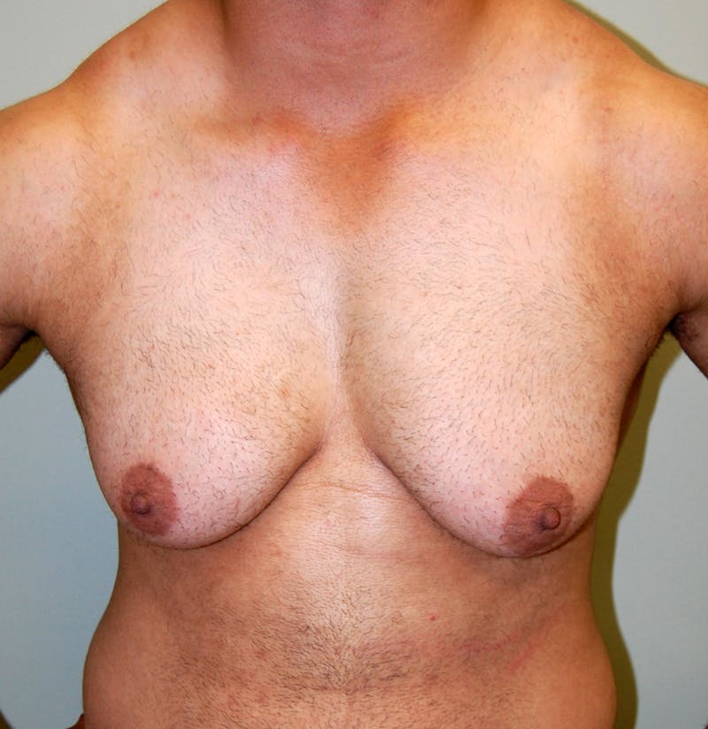 Gynecomastia Before & After Gallery - Patient 200855 - Image 1