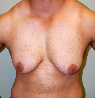 Gynecomastia Before & After Gallery - Patient 200855 - Image 1