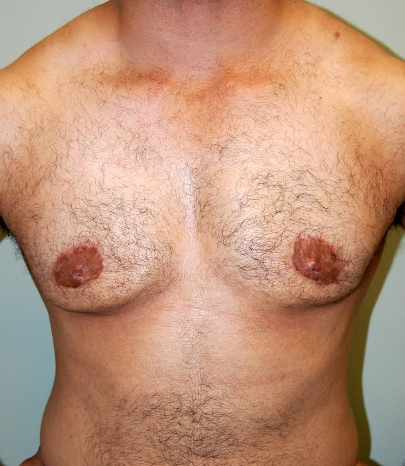 Gynecomastia Before & After Gallery - Patient 200855 - Image 2
