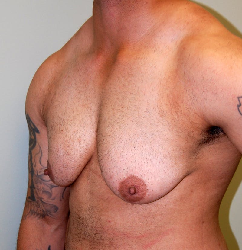 Gynecomastia Before & After Gallery - Patient 200855 - Image 3