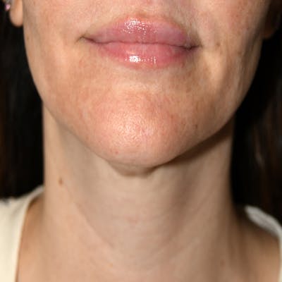 Liposuction Before & After Gallery - Patient 107616 - Image 1