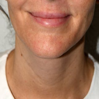 Liposuction Before & After Gallery - Patient 107616 - Image 2