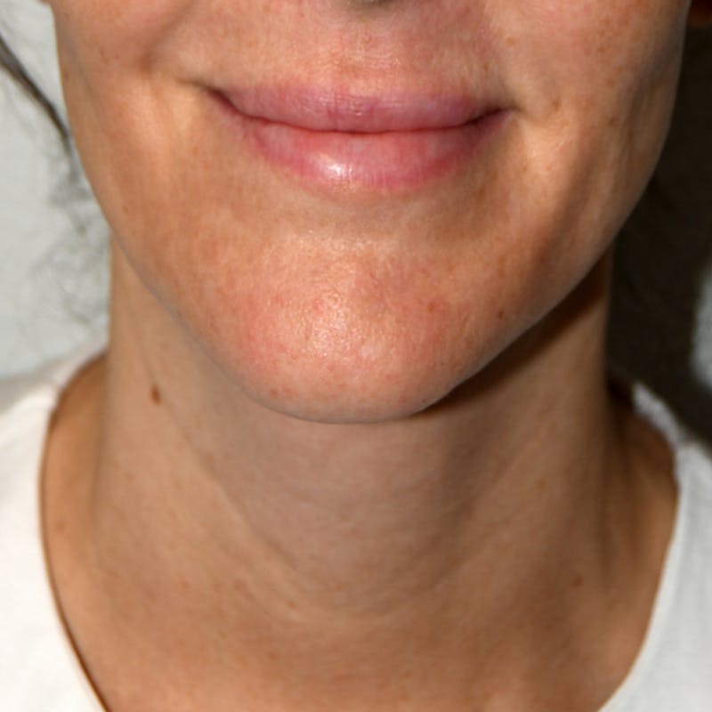 Liposuction Before & After Gallery - Patient 107616 - Image 2