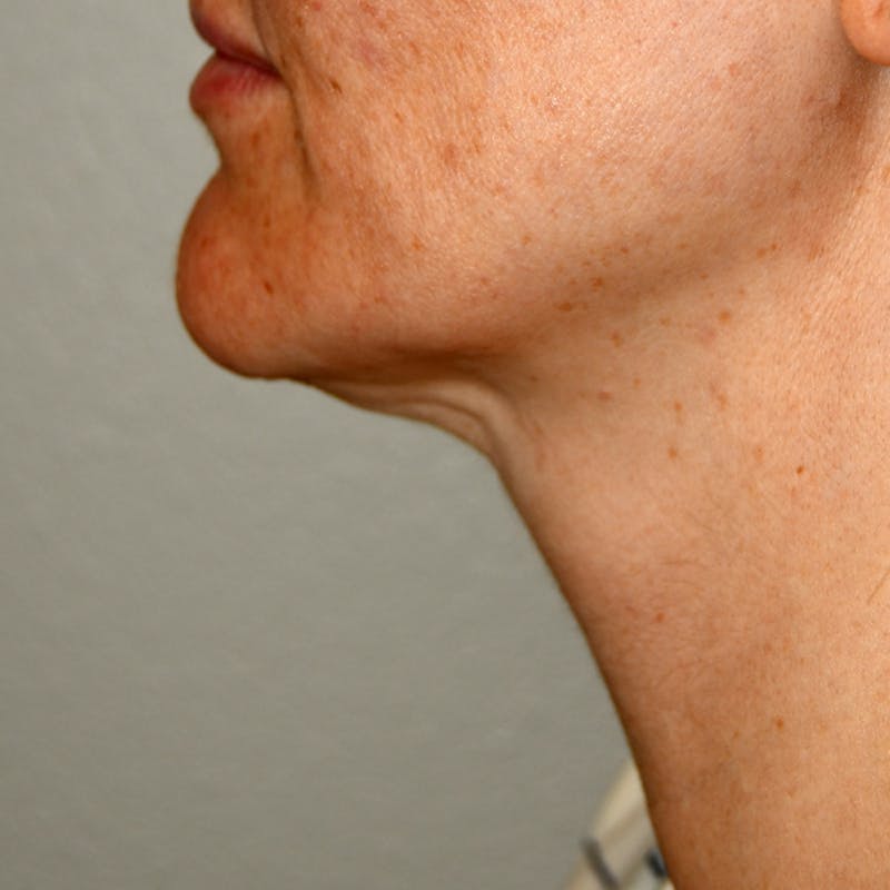 Liposuction Before & After Gallery - Patient 107616 - Image 3