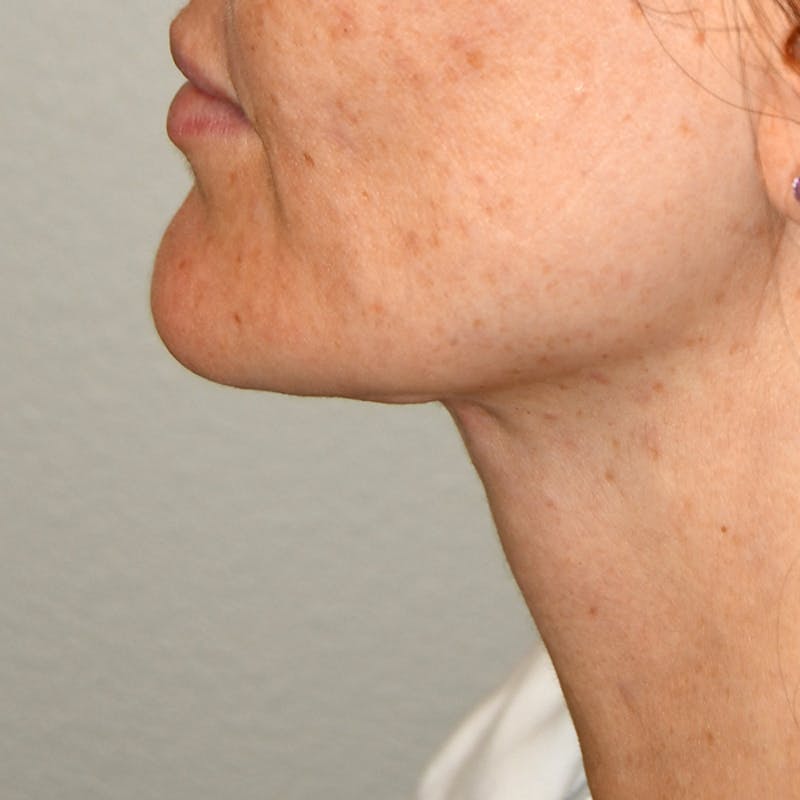 Liposuction Before & After Gallery - Patient 107616 - Image 4