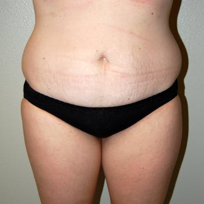 Liposuction Before & After Gallery - Patient 317241 - Image 1