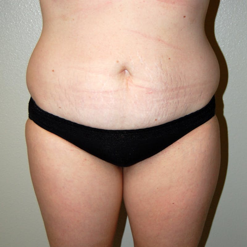 Liposuction Before & After Gallery - Patient 317241 - Image 1