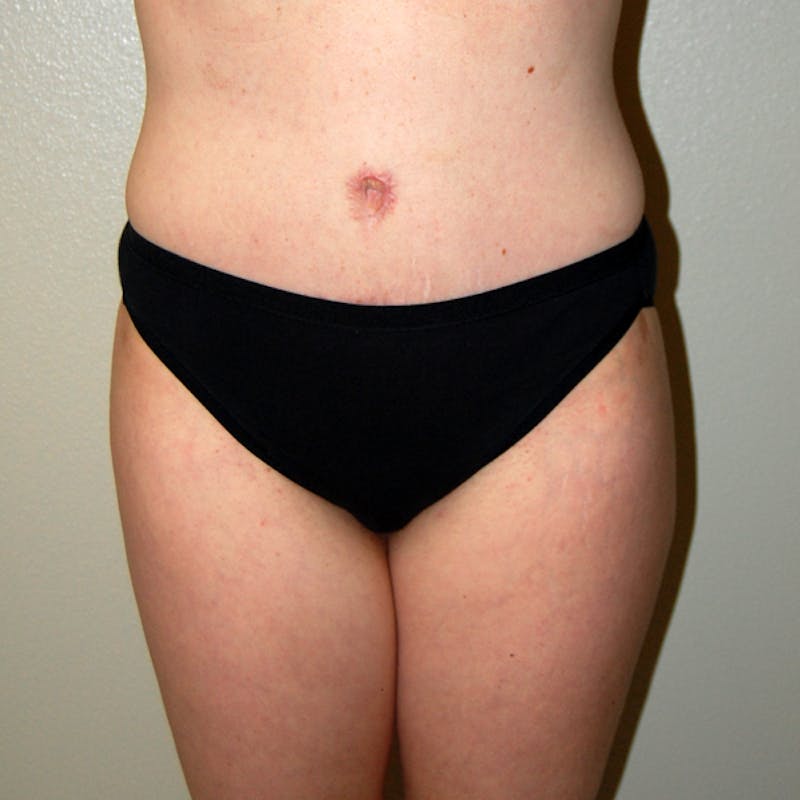 Liposuction Before & After Gallery - Patient 317241 - Image 2