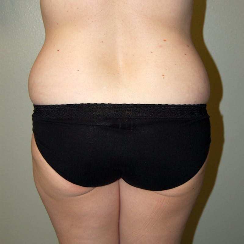 Liposuction Before & After Gallery - Patient 317241 - Image 3