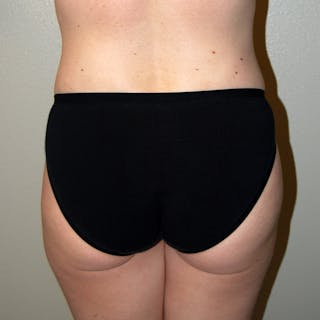 Liposuction Before & After Gallery - Patient 317241 - Image 4