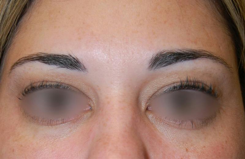 Botox Before & After Gallery - Patient 276985 - Image 1