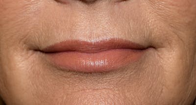 Juvederm Before & After Gallery - Patient 191560 - Image 2
