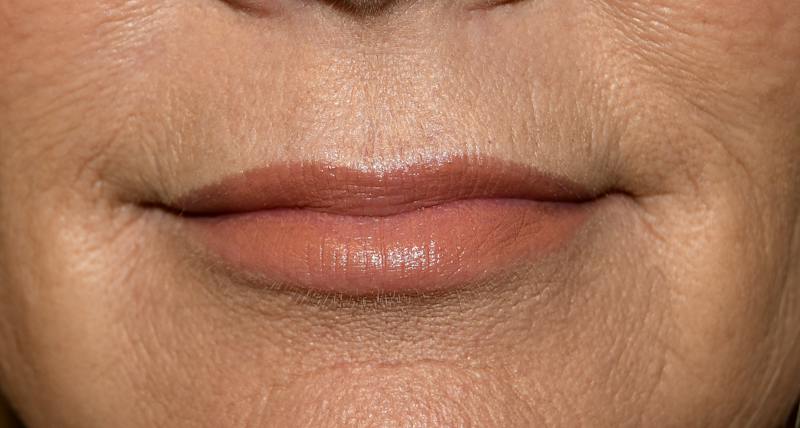 Juvederm Before & After Gallery - Patient 191560 - Image 2