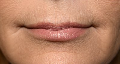 Juvederm Before & After Gallery - Patient 191560 - Image 1