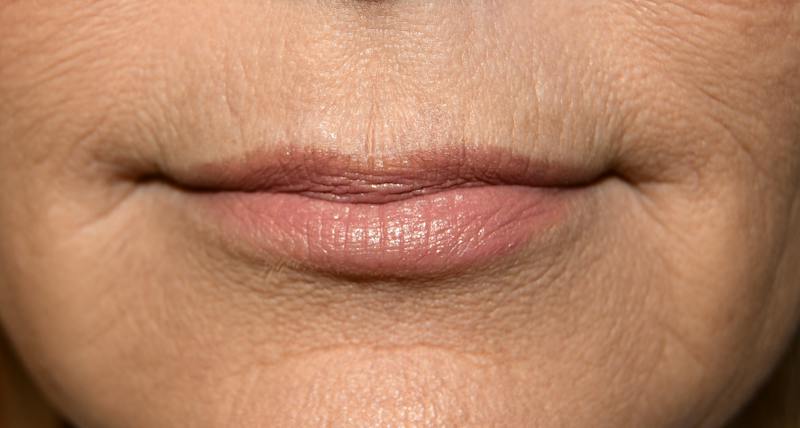 Juvederm Before & After Gallery - Patient 191560 - Image 1