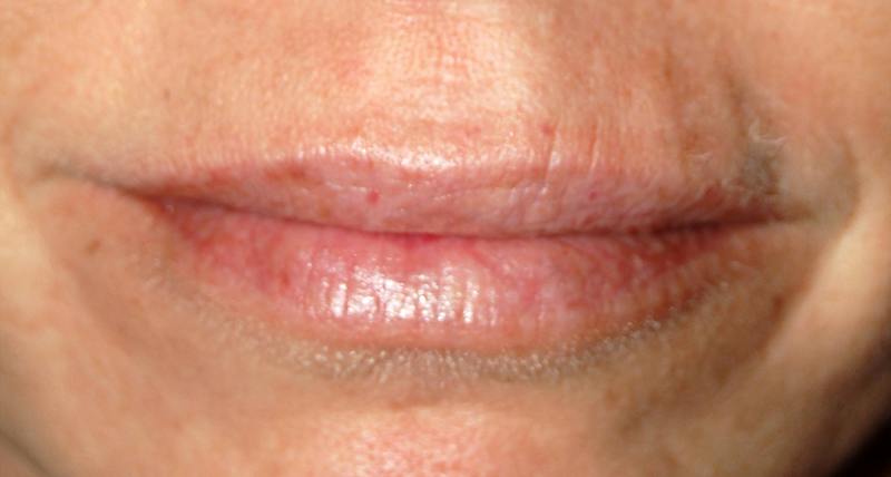 Juvederm Before & After Gallery - Patient 239619 - Image 2