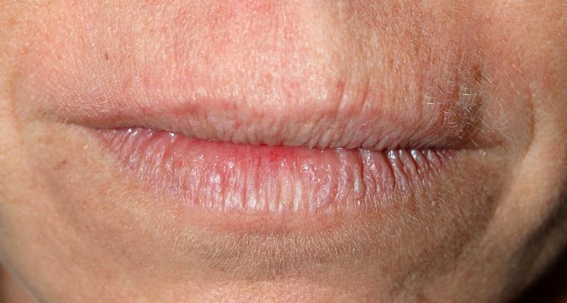Juvederm Before & After Gallery - Patient 239619 - Image 1