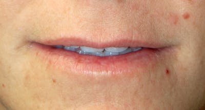 Juvederm Before & After Gallery - Patient 391589 - Image 1