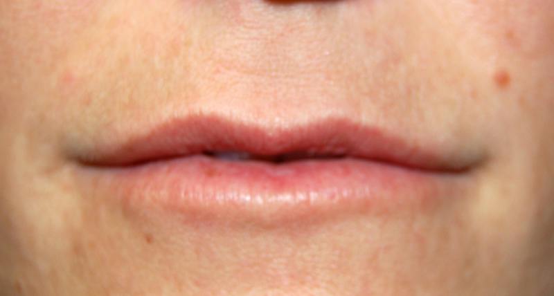 Juvederm Before & After Gallery - Patient 391589 - Image 2