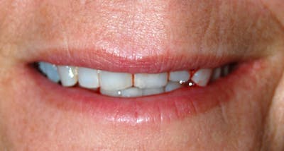 Juvederm Before & After Gallery - Patient 359217 - Image 1