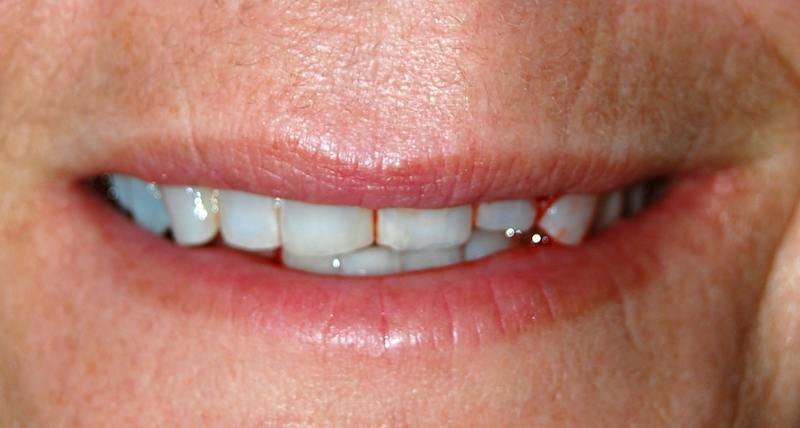 Juvederm Before & After Gallery - Patient 359217 - Image 1