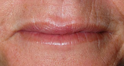Juvederm Before & After Gallery - Patient 359217 - Image 2