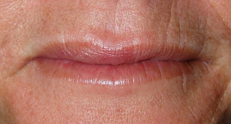 Juvederm Before & After Gallery - Patient 359217 - Image 2