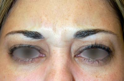 Botox Before & After Gallery - Patient 276985 - Image 1