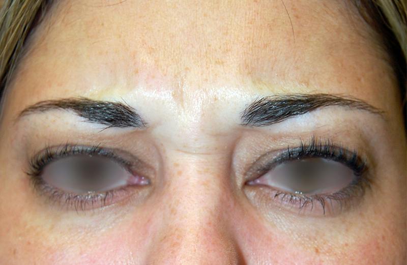 Botox Before & After Gallery - Patient 276985 - Image 1