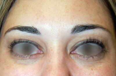 Botox Before & After Gallery - Patient 276985 - Image 2