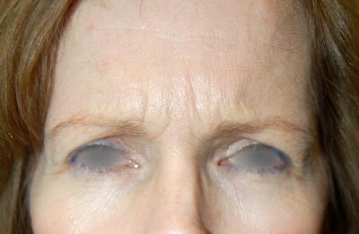 Botox Before & After Gallery - Patient 186239 - Image 1