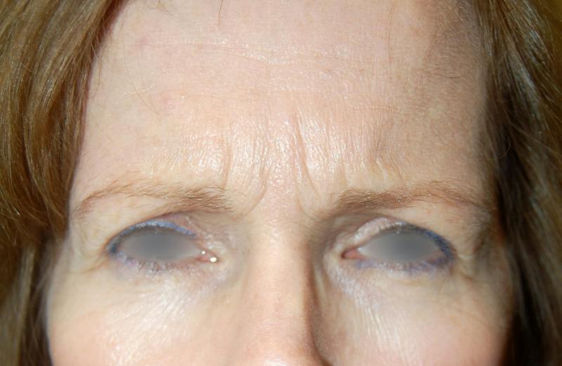 Botox Before & After Gallery - Patient 186239 - Image 1