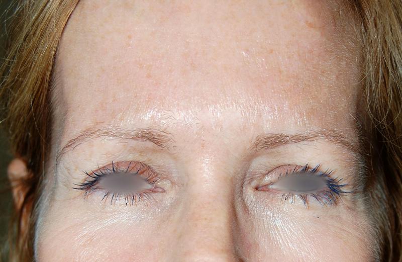 Botox Before & After Gallery - Patient 186239 - Image 2