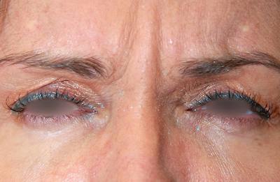 Botox Before & After Gallery - Patient 338458 - Image 1