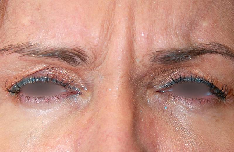 Botox Before & After Gallery - Patient 338458 - Image 1
