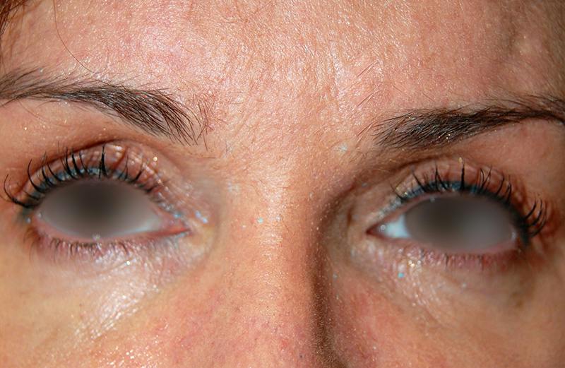 Botox Before & After Gallery - Patient 338458 - Image 2
