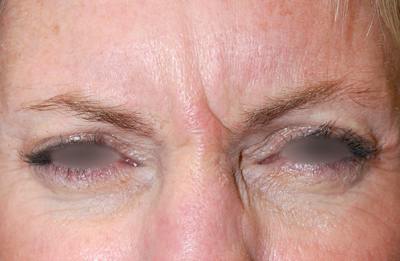 Botox Before & After Gallery - Patient 415646 - Image 1