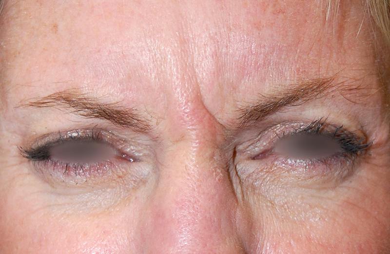 Botox Before & After Gallery - Patient 415646 - Image 1