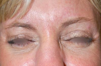 Botox Before & After Gallery - Patient 415646 - Image 2