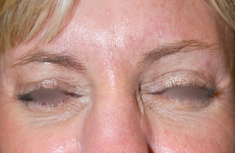 Botox Before & After Gallery - Patient 415646 - Image 2